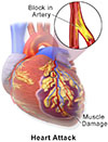 Myocardial infarction (MI), commonly known as a heart attack.